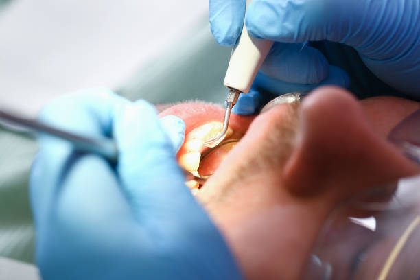 Best Emergency Treatment for Dental Infections or Abscesses in Upton, WY