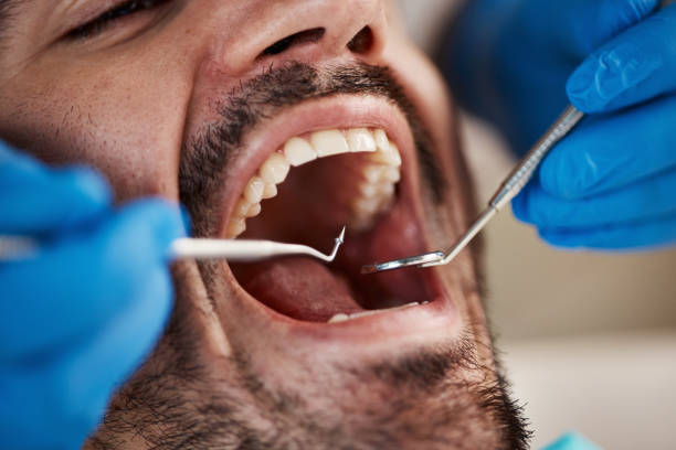 Best Emergency Tooth Extraction in Upton, WY